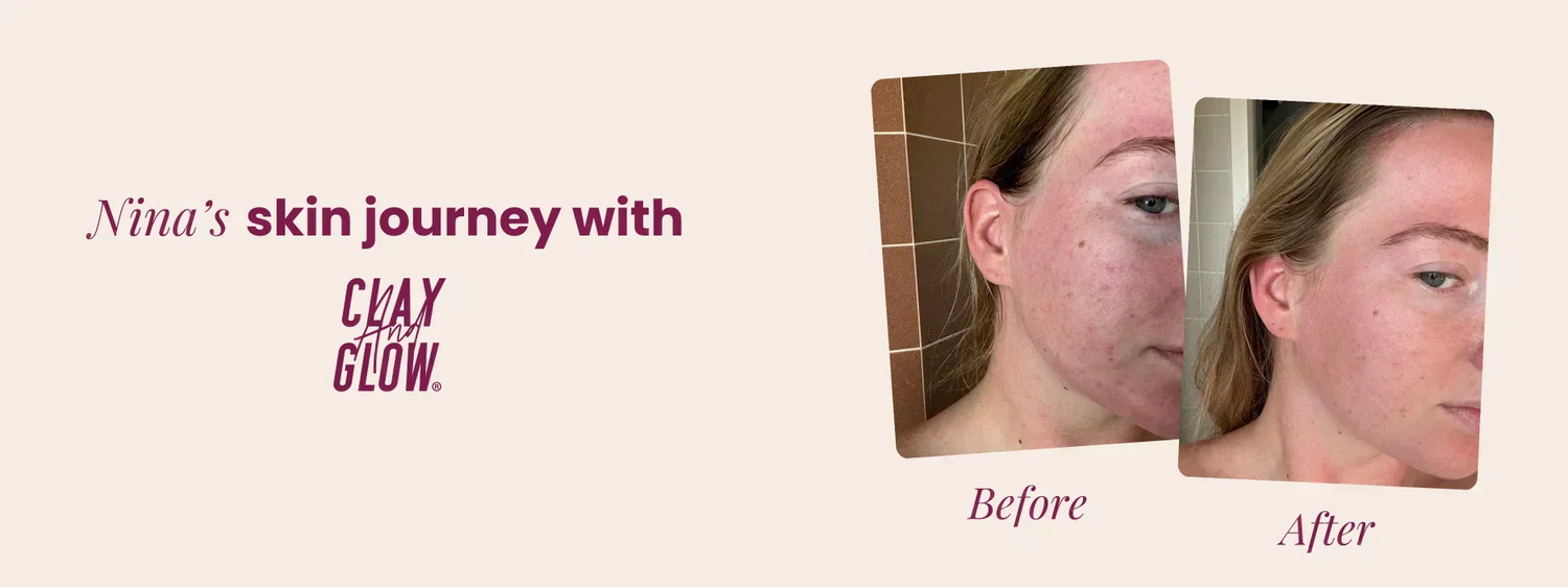 Nina's skin journey with Clay And Glow: From blemishes to a glow